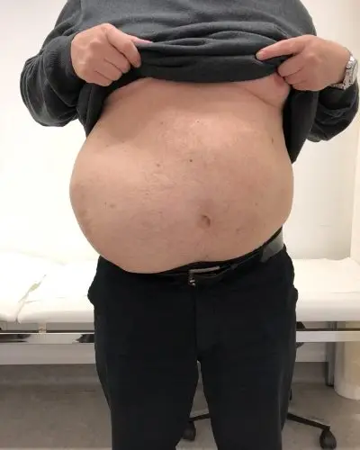 Large incisional hernia after previous abdominal surgery