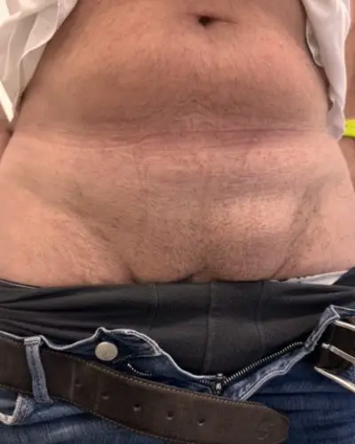 Patient with an inguinal hernia (groin hernia)
