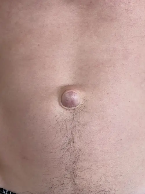 Medium-sized umbilical hernia at the navel